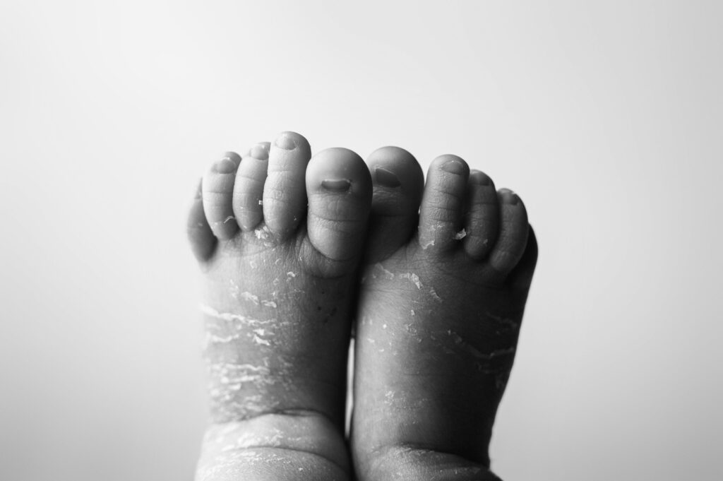 b&w detail photo of baby feet with peeling skin.