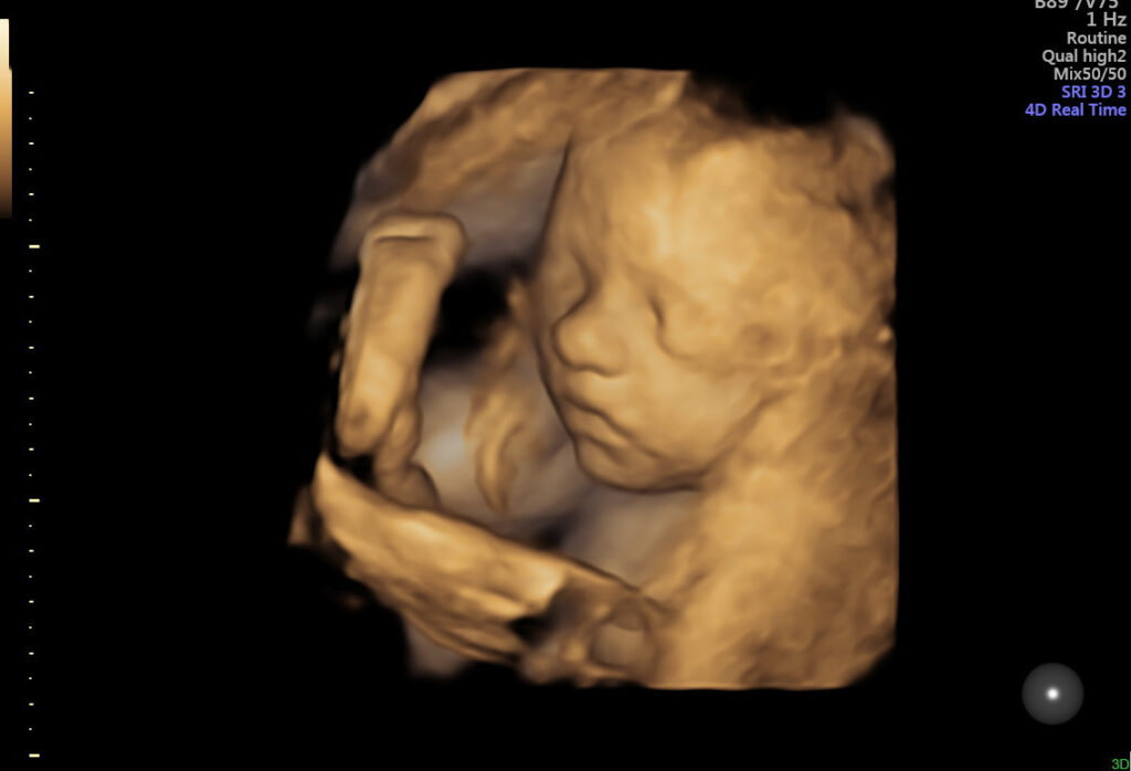 a 3d ultrasound of a baby in utero 